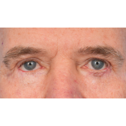 Revision Blepharoplasty Before & After Patient #3458