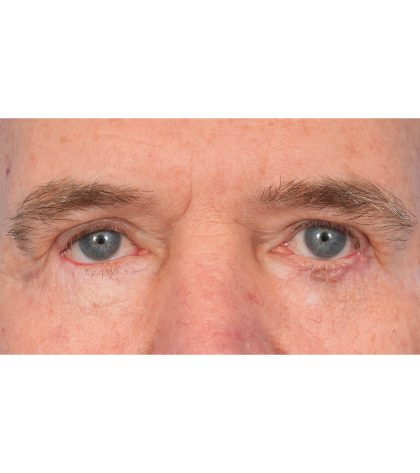 Revision Blepharoplasty Before & After Patient #3458