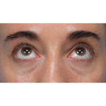 CO2 Laser Resurfacing Before & After Patient #3533