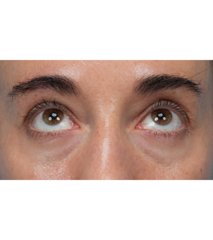 CO2 Laser Resurfacing Before & After Patient #3533