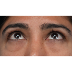 Lower Blepharoplasty Before & After Patient #3521