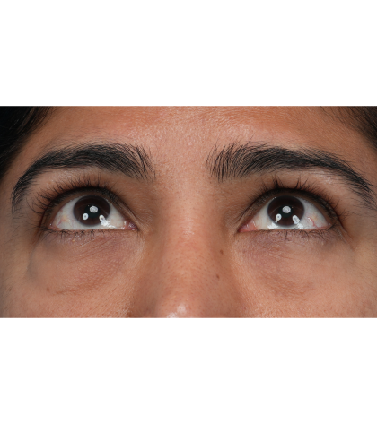 Lower Blepharoplasty Before & After Patient #3521
