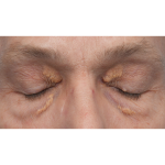 Lesion Removal Before & After Patient #3484