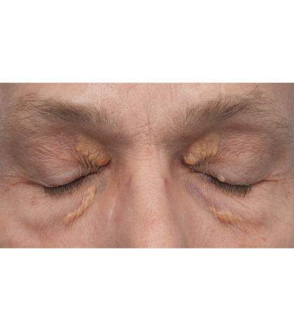 Lesion Removal Before & After Patient #3484