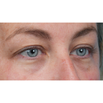 Upper Blepharoplasty Before & After Patient #3495