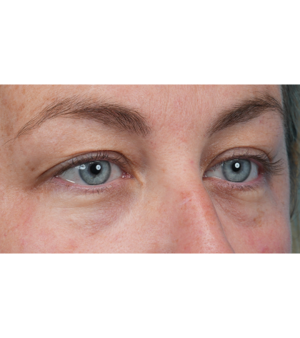 Upper Blepharoplasty Before & After Patient #3495
