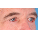 Revision Blepharoplasty Before & After Patient #3458