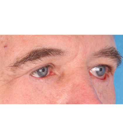 Revision Blepharoplasty Before & After Patient #3458