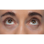 CO2 Laser Resurfacing Before & After Patient #3533