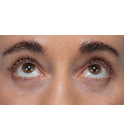 CO2 Laser Resurfacing Before & After Patient #3533