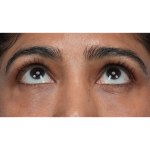 Lower Blepharoplasty Before & After Patient #3521