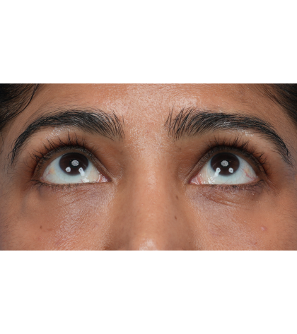 Lower Blepharoplasty Before & After Patient #3521