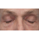 Lesion Removal Before & After Patient #3484