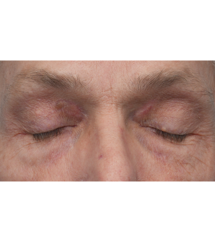 Lesion Removal Before & After Patient #3484