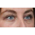 Upper Blepharoplasty Before & After Patient #3495