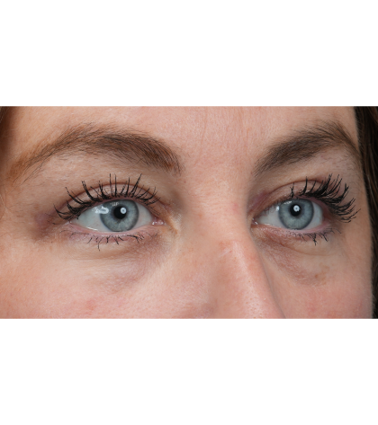 Upper Blepharoplasty Before & After Patient #3495