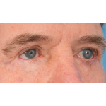 Revision Blepharoplasty Before & After Patient #3458