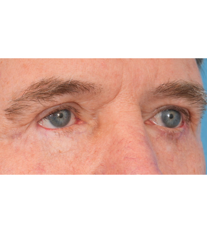 Revision Blepharoplasty Before & After Patient #3458