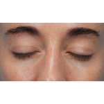 CO2 Laser Resurfacing Before & After Patient #3533
