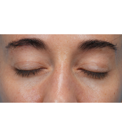 CO2 Laser Resurfacing Before & After Patient #3533