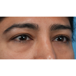 Lower Blepharoplasty Before & After Patient #3521