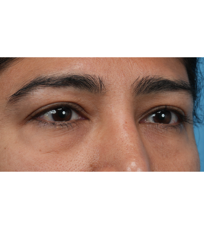 Lower Blepharoplasty Before & After Patient #3521