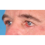 Revision Blepharoplasty Before & After Patient #3458