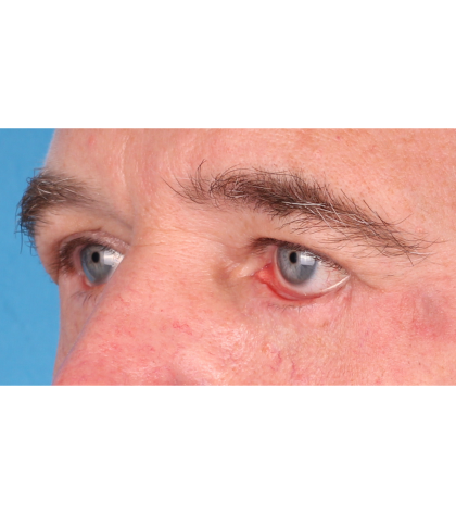 Revision Blepharoplasty Before & After Patient #3458