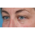 Upper Blepharoplasty Before & After Patient #3495
