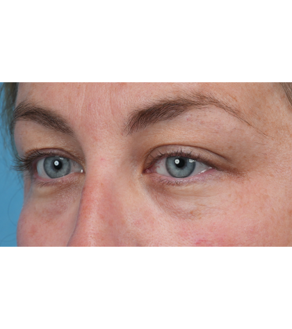Upper Blepharoplasty Before & After Patient #3495