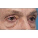 Lesion Removal Before & After Patient #3484