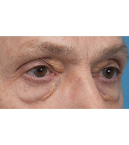Lesion Removal Before & After Patient #3484