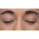 CO2 Laser Resurfacing Before & After Patient #3533