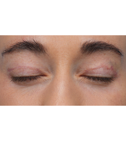CO2 Laser Resurfacing Before & After Patient #3533
