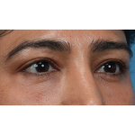 Lower Blepharoplasty Before & After Patient #3521