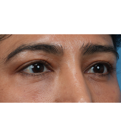 Lower Blepharoplasty Before & After Patient #3521