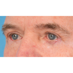 Revision Blepharoplasty Before & After Patient #3458