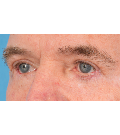 Revision Blepharoplasty Before & After Patient #3458