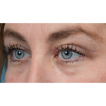Upper Blepharoplasty Before & After Patient #3495