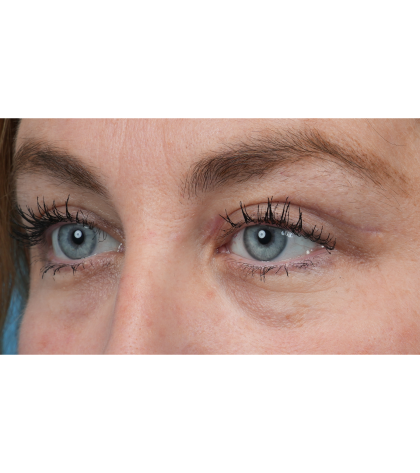 Upper Blepharoplasty Before & After Patient #3495