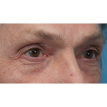 Lesion Removal Before & After Patient #3484