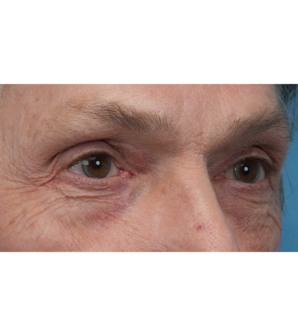 Lesion Removal Before & After Patient #3484