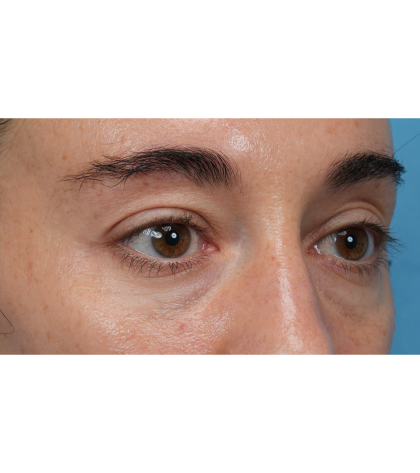 CO2 Laser Resurfacing Before & After Patient #3533