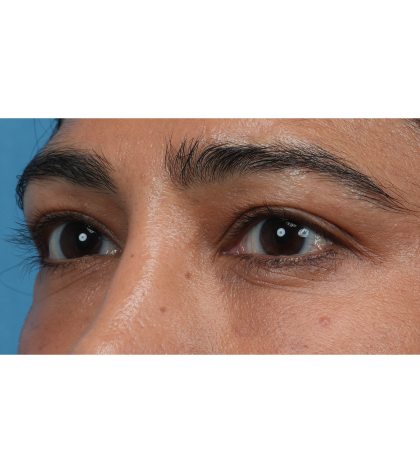 Lower Blepharoplasty Before & After Patient #3521