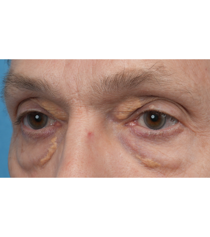 Lesion Removal Before & After Patient #3484