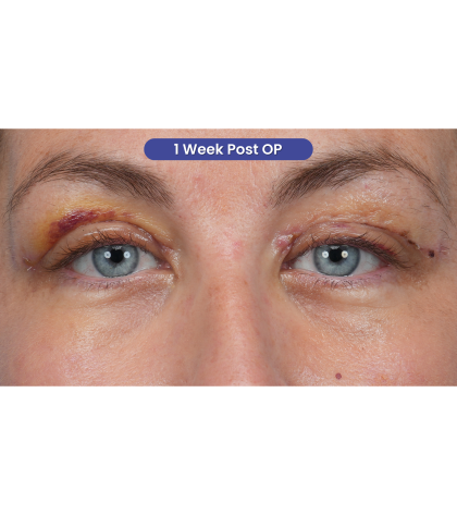 Upper Blepharoplasty Before & After Patient #3495