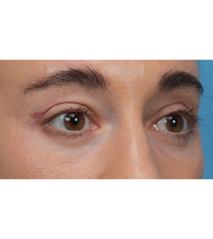 CO2 Laser Resurfacing Before & After Patient #3533