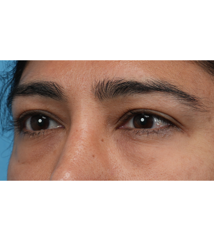Lower Blepharoplasty Before & After Patient #3521