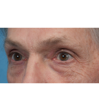 Lesion Removal Before & After Patient #3484