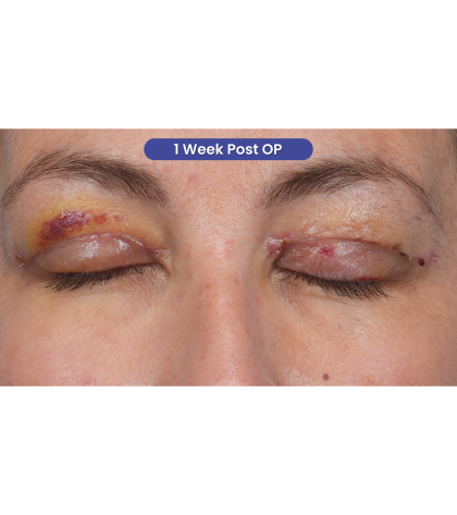 Upper Blepharoplasty Before & After Patient #3495